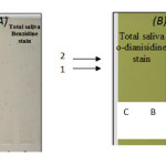Fig 4: The electrogram pattern of peroxidase forms present in saliva samples of Ossifying Fibroma patients group using: 